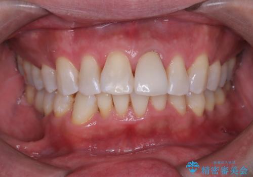 男性のエアーフローとオフィスホワイトニングの症例 治療後