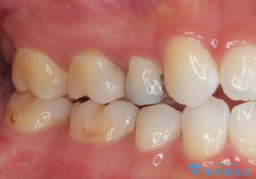 銀歯をやり替えたい セラミックインレー修復の治療後