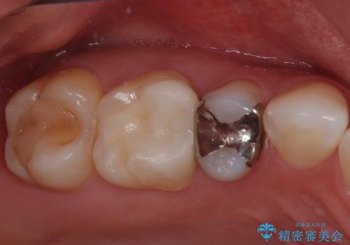 銀歯をやり替えたい セラミックインレー修復の症例 治療後