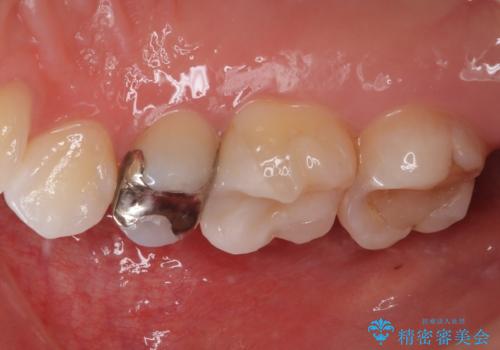 銀歯をやり替えたい セラミックインレー修復の治療後
