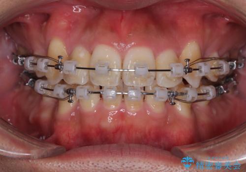 八重歯と前歯のガタガタを抜歯矯正で治療|クリアブラケット使用例の治療中