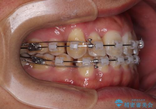 八重歯と前歯のガタガタを抜歯矯正で治療|クリアブラケット使用例の治療中