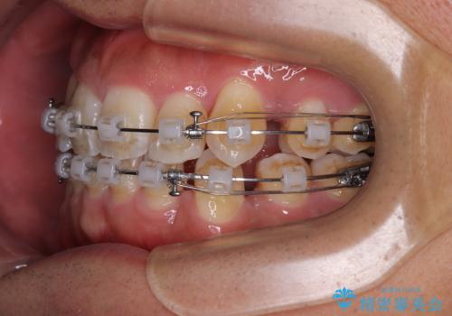 八重歯と前歯のガタガタを抜歯矯正で治療|クリアブラケット使用例の治療中