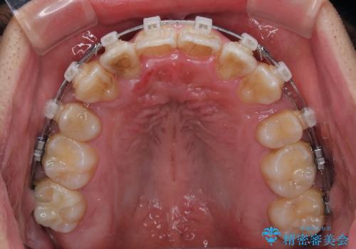 八重歯と前歯のガタガタを抜歯矯正で治療|クリアブラケット使用例の治療中