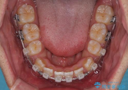 八重歯と前歯のガタガタを抜歯矯正で治療|クリアブラケット使用例の治療中