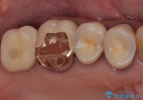 食事が取れないほどの激痛 奥歯のインプラント治療の症例 治療後