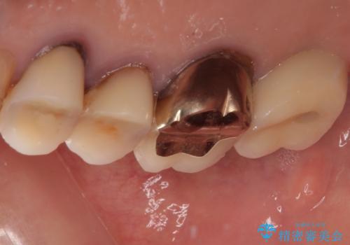 食事が取れないほどの激痛 奥歯のインプラント治療の治療後