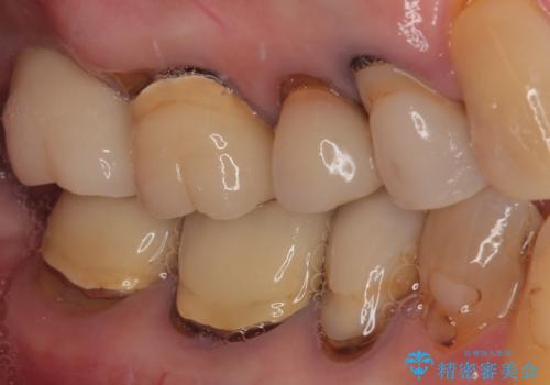 食事が取れないほどの激痛 奥歯のインプラント治療の治療後