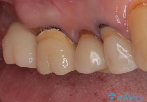 食事が取れないほどの激痛 奥歯のインプラント治療の治療後