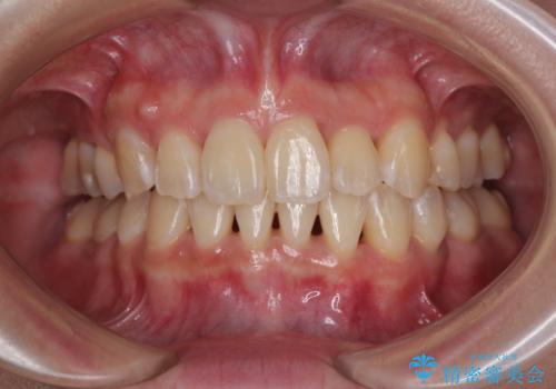 【モニター】前歯のデコボコをワイヤーの抜歯矯正で綺麗に整えるの症例 治療後