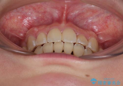 【モニター】前歯のデコボコをワイヤーの抜歯矯正で綺麗に整えるの治療後