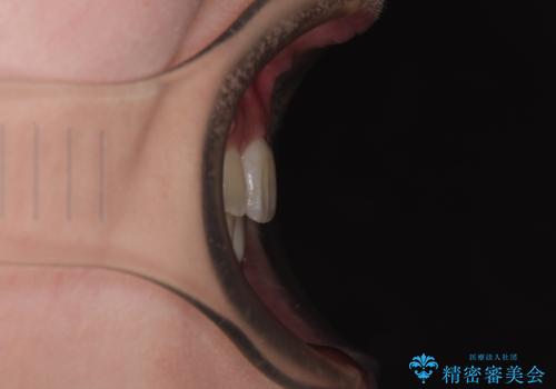 【モニター】前歯のデコボコをワイヤーの抜歯矯正で綺麗に整えるの治療後