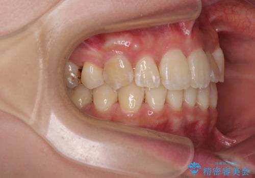 【モニター】前歯のデコボコをワイヤーの抜歯矯正で綺麗に整えるの治療後