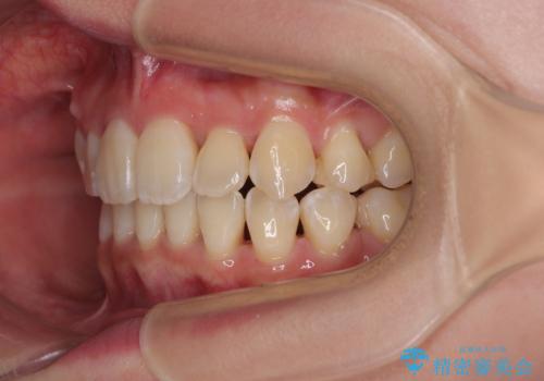 【モニター】前歯のデコボコをワイヤーの抜歯矯正で綺麗に整えるの治療後