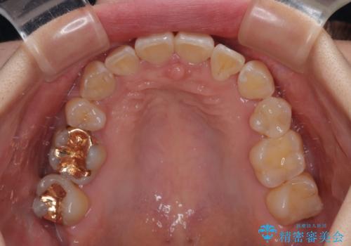 【モニター】前歯のデコボコをワイヤーの抜歯矯正で綺麗に整えるの治療後