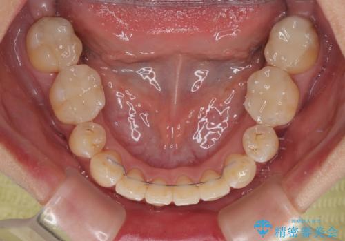 【モニター】前歯のデコボコをワイヤーの抜歯矯正で綺麗に整えるの治療後