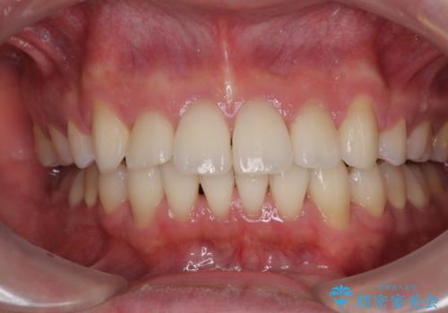 【モニター】八重歯とデコボコを治したい 補助装置を併用したワイヤー矯正の治療後