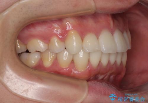 【モニター】八重歯とデコボコを治したい 補助装置を併用したワイヤー矯正の治療後