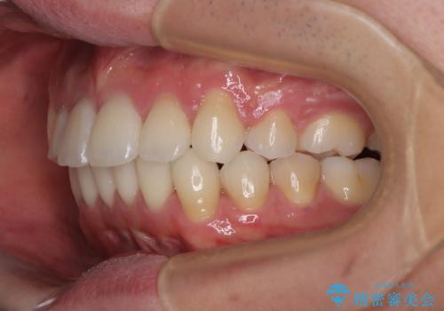 【モニター】八重歯とデコボコを治したい 補助装置を併用したワイヤー矯正の治療後