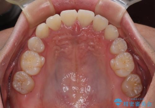【モニター】八重歯とデコボコを治したい　補助装置を併用したワイヤー矯正の治療後