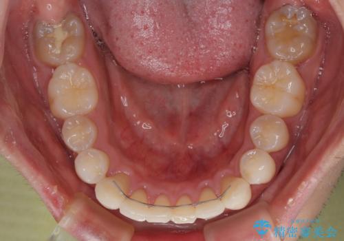 【モニター】八重歯とデコボコを治したい 補助装置を併用したワイヤー矯正の治療後