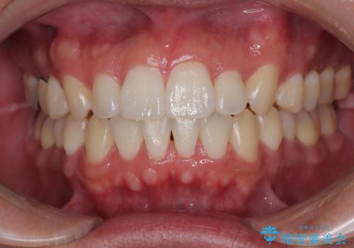 前歯のデコボコをささっと治す 短期間でのインビザライン矯正治療の症例 治療後