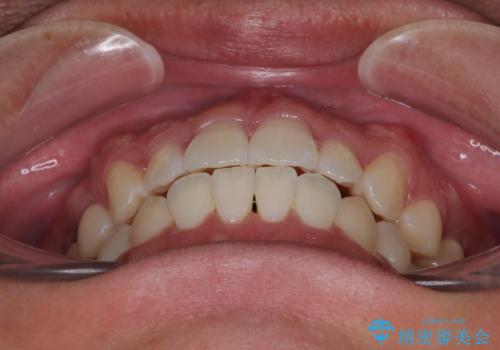 前歯のデコボコをささっと治す 短期間でのインビザライン矯正治療の治療後