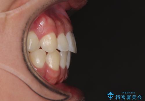前歯のデコボコをささっと治す 短期間でのインビザライン矯正治療の治療後