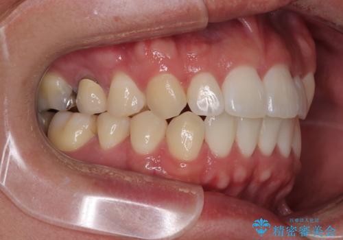 前歯のデコボコをささっと治す 短期間でのインビザライン矯正治療の治療後