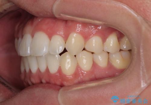 前歯のデコボコをささっと治す 短期間でのインビザライン矯正治療の治療後