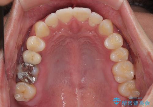 前歯のデコボコをささっと治す 短期間でのインビザライン矯正治療の治療後