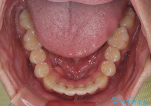 前歯のデコボコをささっと治す 短期間でのインビザライン矯正治療の治療後