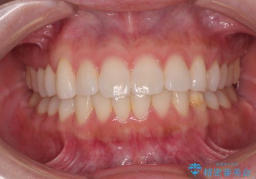 気になる前歯を短期間で治す インビザライン・モデレートでの矯正治療の治療中