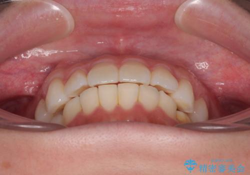 気になる前歯を短期間で治す インビザライン・モデレートでの矯正治療の治療中