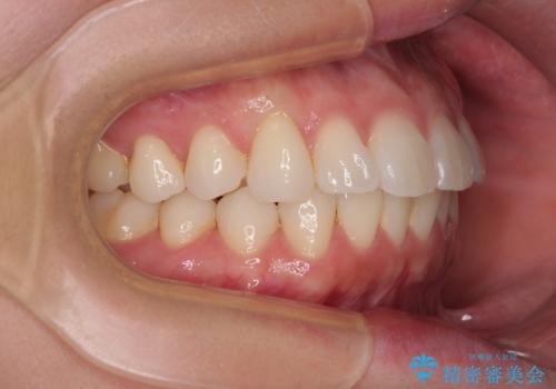 気になる前歯を短期間で治す インビザライン・モデレートでの矯正治療の治療中