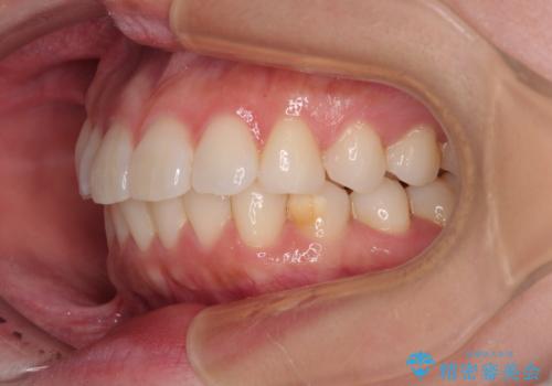気になる前歯を短期間で治す インビザライン・モデレートでの矯正治療の治療中