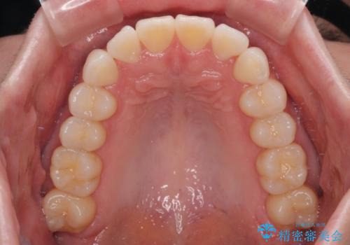 気になる前歯を短期間で治す インビザライン・モデレートでの矯正治療の治療中