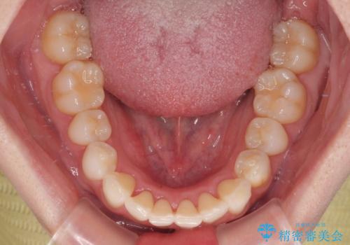 気になる前歯を短期間で治す インビザライン・モデレートでの矯正治療の治療中