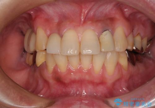 放置した破折歯 即時・早期のインプラント埋入による補綴治療