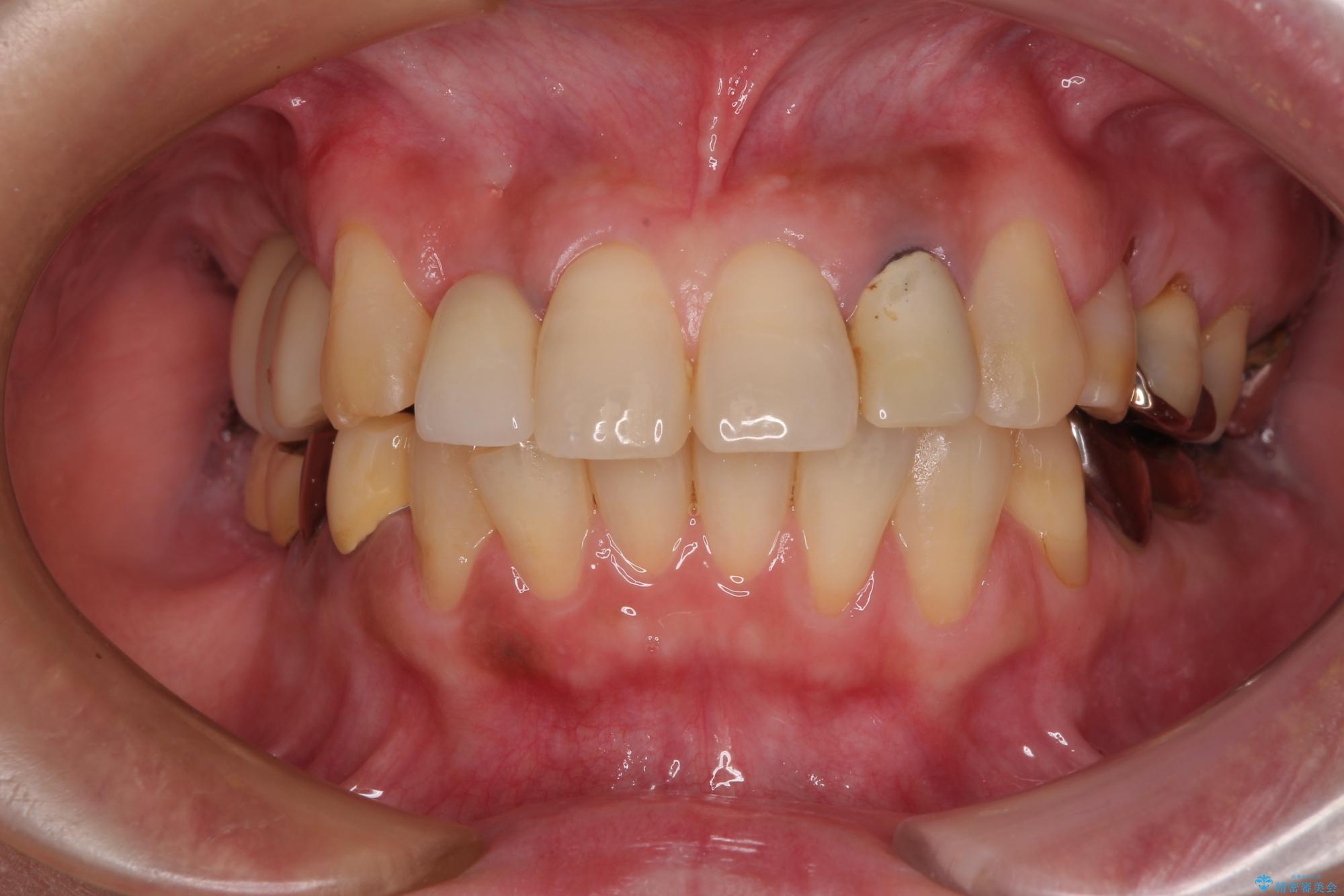 裁断済み】矯正が先か？インプラントが先か？ 欠損補綴の治療計画を