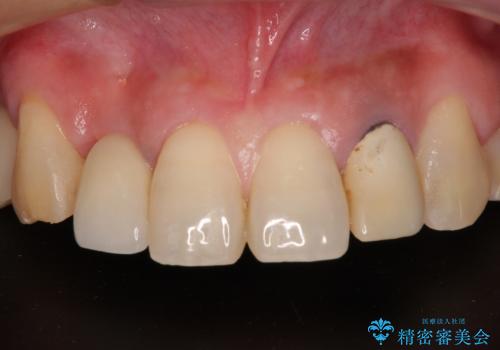 放置した破折歯 即時・早期のインプラント埋入による補綴治療の治療後