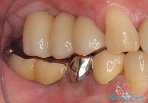 放置した破折歯 即時・早期のインプラント埋入による補綴治療の治療後