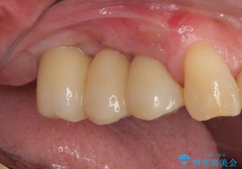 放置した破折歯 即時・早期のインプラント埋入による補綴治療の治療後