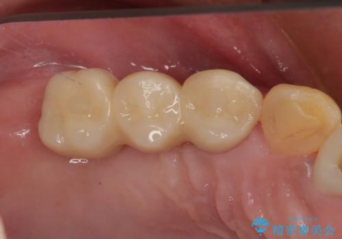 放置した破折歯 即時・早期のインプラント埋入による補綴治療の治療後