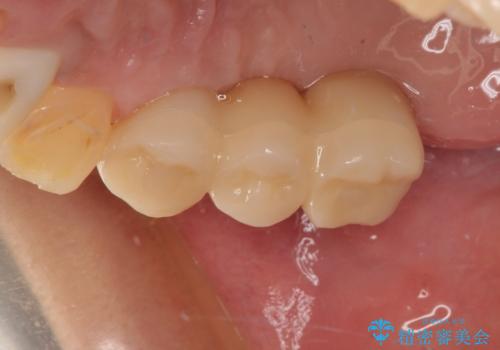 放置した破折歯 即時・早期のインプラント埋入による補綴治療の治療後