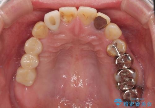 放置した破折歯 即時・早期のインプラント埋入による補綴治療の症例 治療後