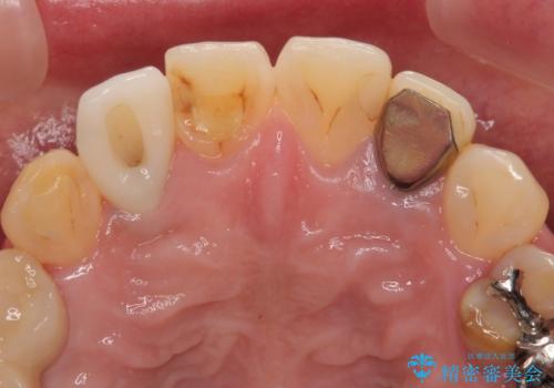放置した破折歯 即時・早期のインプラント埋入による補綴治療の治療後