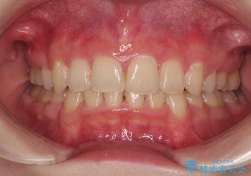 【モニター】デコボコと隠れてしまう前歯 ワイヤー装置による抜歯矯正で美しい口元にの症例 治療後