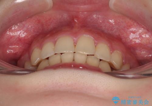 【モニター】デコボコと隠れてしまう前歯 ワイヤー装置による抜歯矯正で美しい口元にの治療後