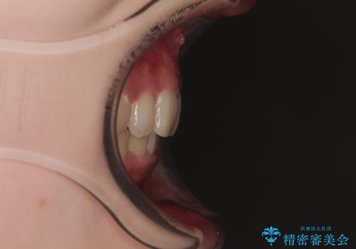 【モニター】デコボコと隠れてしまう前歯 ワイヤー装置による抜歯矯正で美しい口元にの治療後